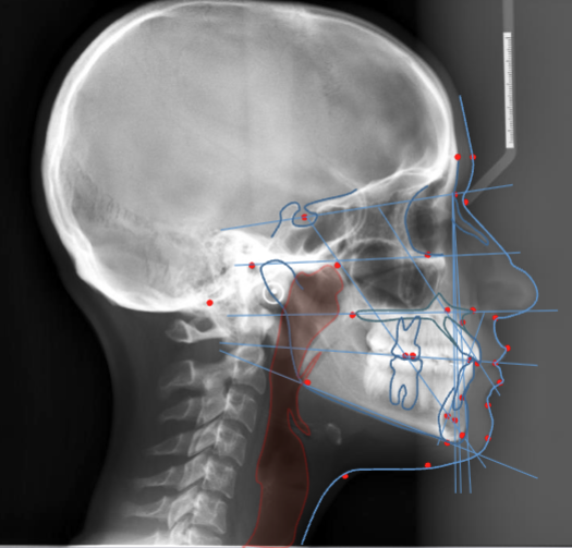 <p>nasopharyngeal soft tissues + paranasal sinuses</p>