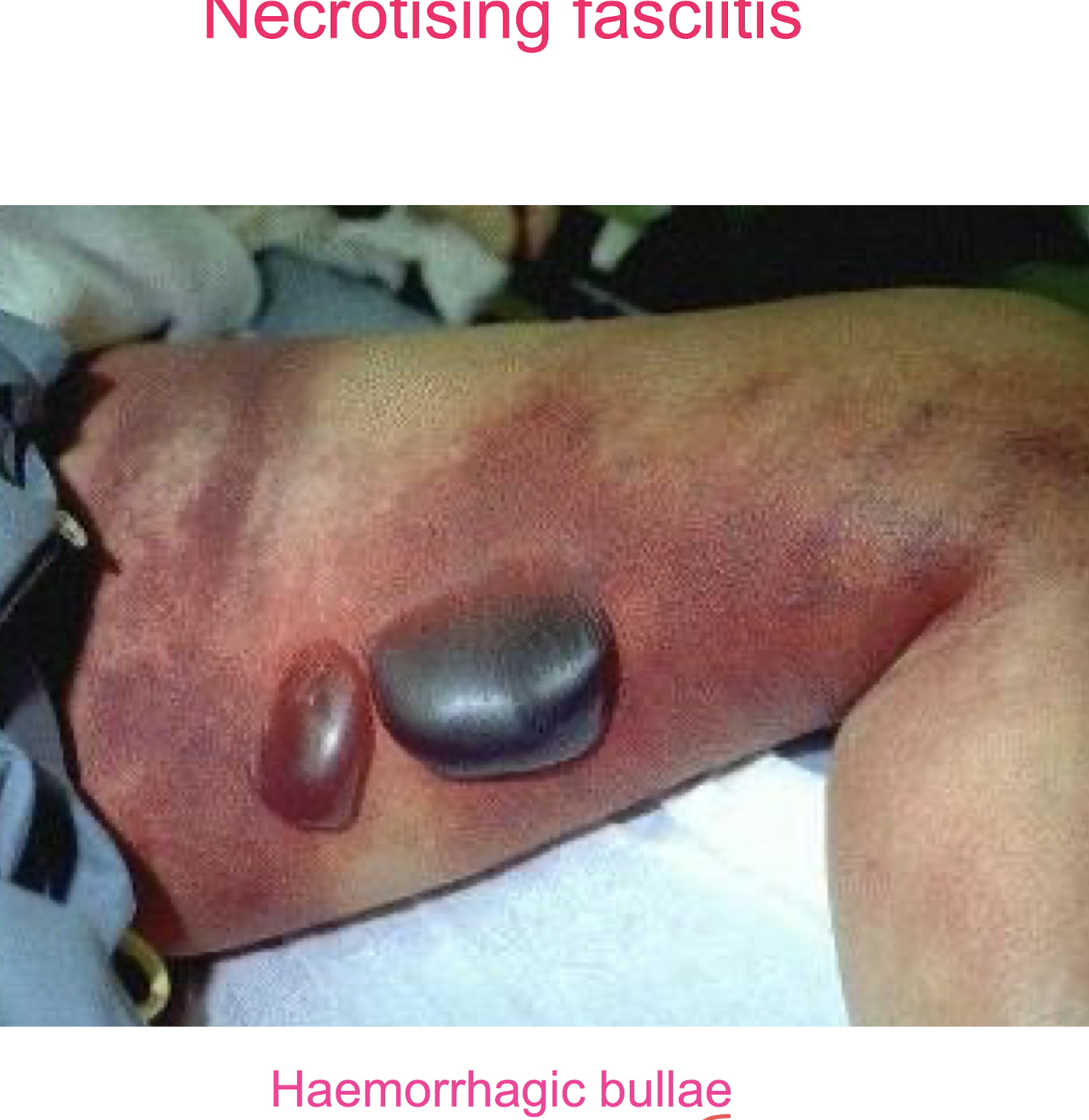 <p><strong><em>Streptococcus pyogenes</em></strong>, also known as Group A Streptococcus (GAS), is the primary bacteria associated with necrotising fasciitis, a <strong><mark data-color="red" style="background-color: red; color: inherit;">severe soft tissue infection with extensive oedema, erythema, bullae formation + necrosis</mark></strong></p>