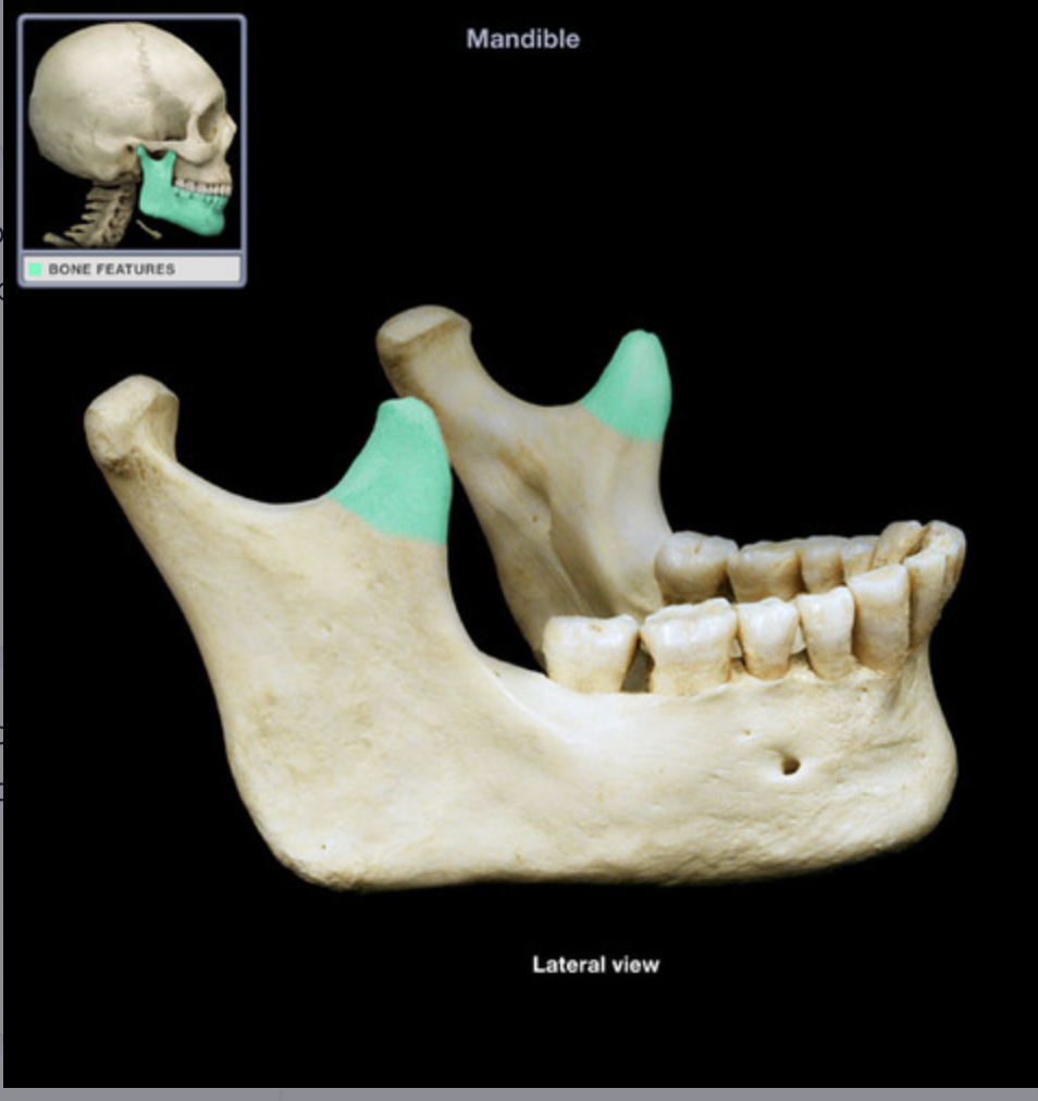 <p>insertion of temporalis</p>