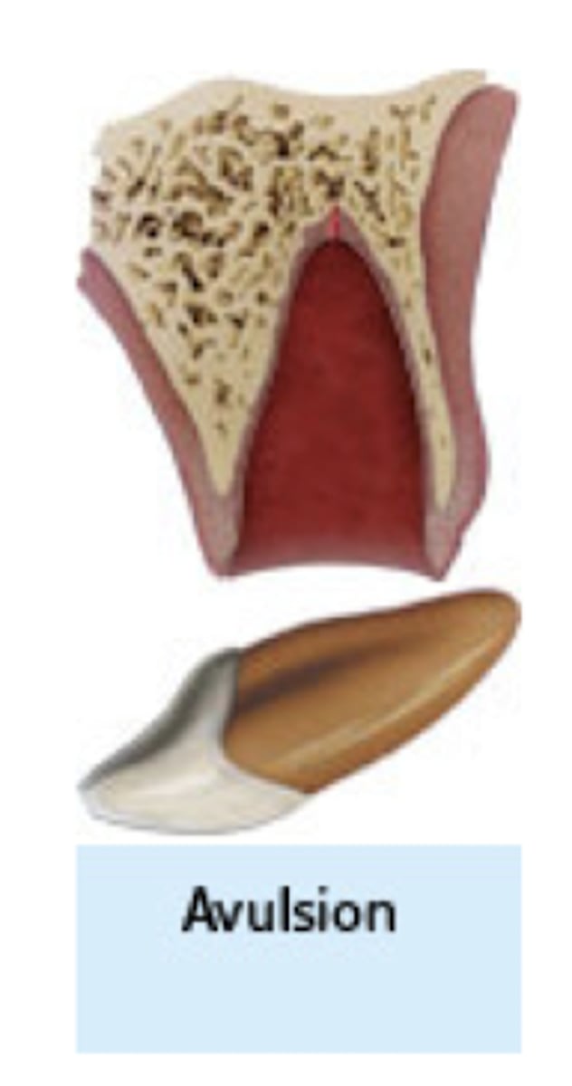 <p>what type of traumatic injury:</p><p>- The tooth is separated from socket</p><p>completely</p><p>- PDL torn</p>