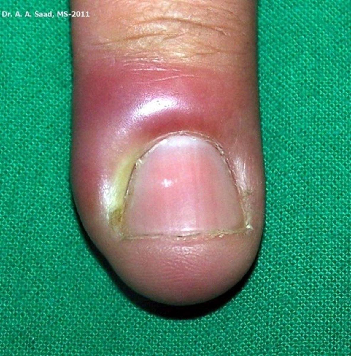 <p>superficial infection of the proximal and lateral nail folds</p>