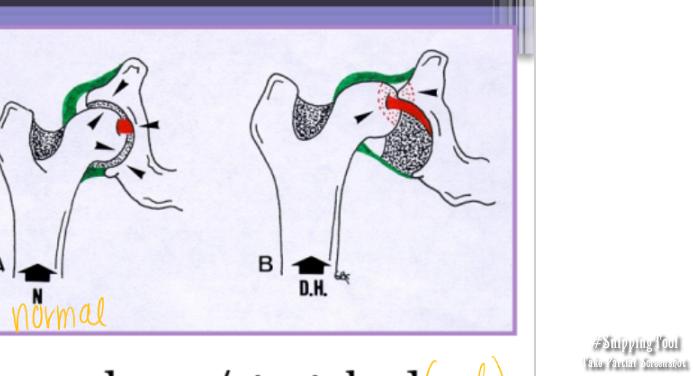 <p><span style="background-color: transparent;"><strong><span>Pathogenesis of Hip Dysplasia</span></strong></span></p>