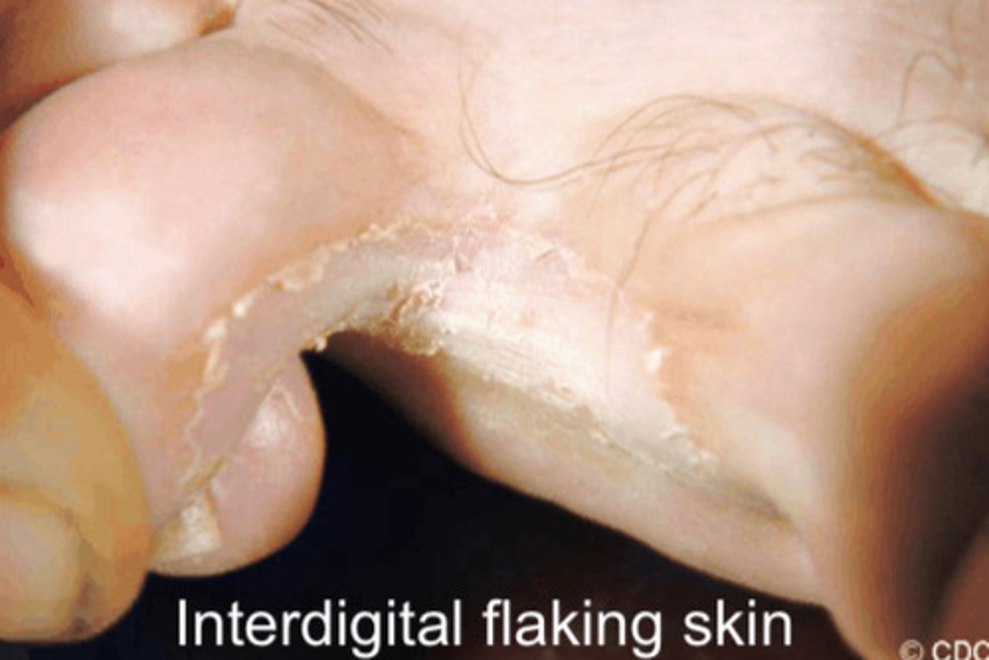 <p>- Itching, flaking, fissuring of skin</p><p>- Plantar foot dry and scaly</p><p>- Can infect toe nails</p>
