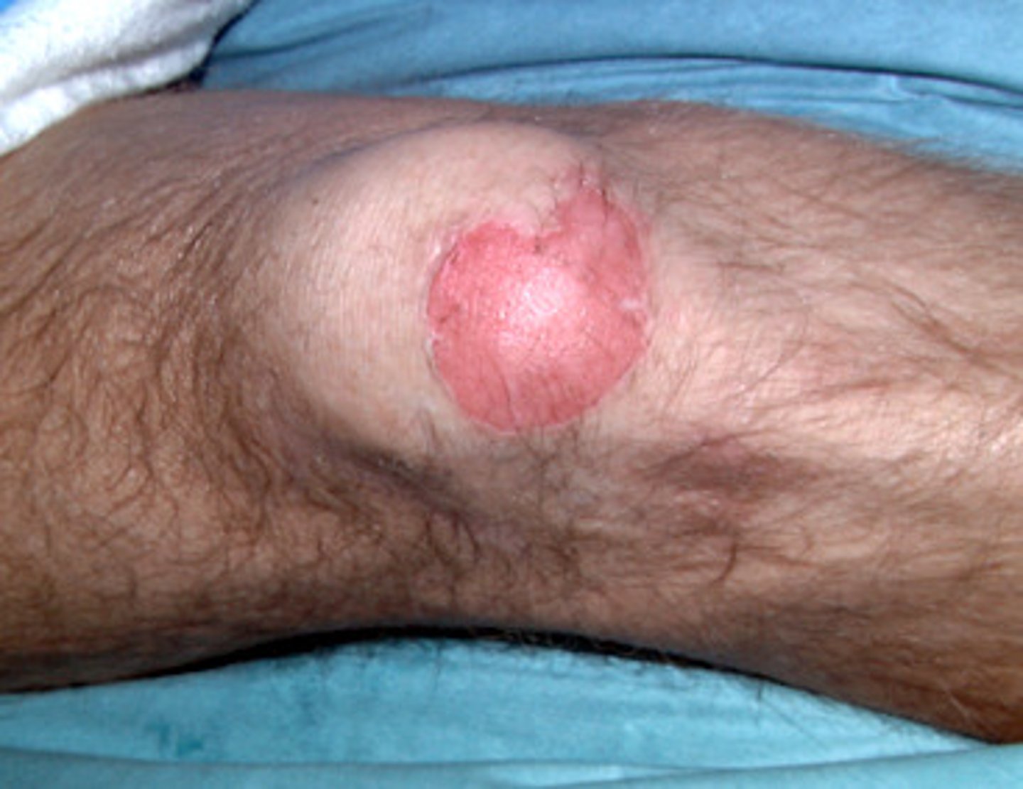 <p>what type of burn is this describing?</p><p>blistering of skin and exposed dermis is red and moist and very painful </p>