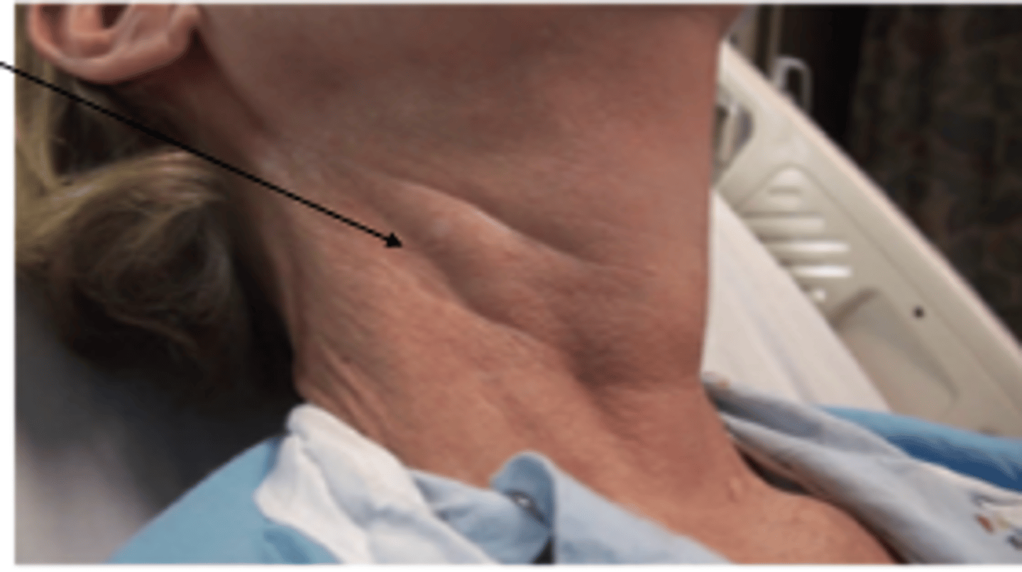<p>pulsatile mass due to kinking or buckling of the carotid artery low in the neck, caution not to mistake for carotid aneurysm which is true dilation of the artery!</p><p>systolic bruits heard in carotid artery/arteries indicate stenosis from atherosclerotic plaque (vs usually innocent in younger patients)</p>
