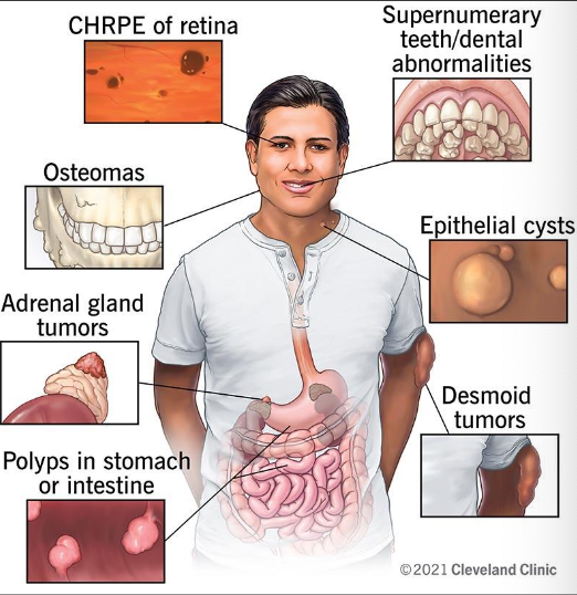<p>What are the clinical features of Gardner Syndrome</p>