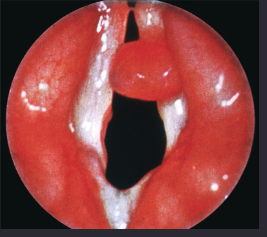 <p>true vocal cords </p>