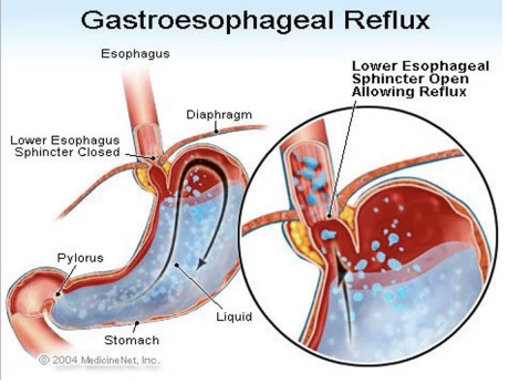 <ul><li><p>reflux of gastric content from gastroduodenal contents into the esophagus</p><ul><li><p>aka lower esophageal dysfunction because it does not stay closed so gastric contents comes up</p></li></ul></li><li><p>complications (if GERD is not taken care of)</p><ul><li><p>aspiration pneumonia, asthma</p></li><li><p>esophagitis (can be pre-cancer)</p></li></ul></li></ul><p></p>