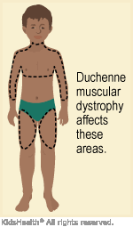 <p><strong>The parents of a 3-year-old boy have brought him to a pediatrician for assessment of the boy's late ambulation and frequent falls. Subsequent muscle biopsy has confirmed a diagnosis of Duchenne muscular dystrophy. Which of the following teaching points should the physician include when explaining the child's diagnosis to his parents?</strong></p><p>A) “Your son's muscular dystrophy is a result of faulty connections between muscles and the nerves that normally control them.”</p><p>B) “He'll require intensive physical therapy as he grows up, and there's a good chance that he will outgrow this problem as he develops.”</p><p>C) “Your son will be prone to heart problems and decreased lung function because of this.”</p><p>D) “His muscles will weaken and will visibly decrease in size relative to his body size throughout his childhood.”</p>