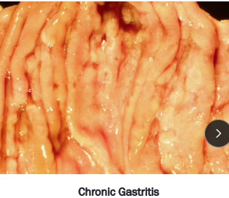 <ul><li><p><strong><u>Inflammation of the gastric mucosa: requires biopsy</u></strong></p><ul><li><p>Lymphoplasmacytic most common</p></li><li><p><u>Cats</u> = part of diffuse IBD</p></li></ul></li></ul><ul><li><p><span style="background-color: transparent;"><strong><span>Acute </span></strong></span></p><ul><li><p><span style="background-color: transparent;"><strong><span>Et:</span></strong></span><span style="background-color: transparent; color: red;"><strong><span> </span><u><span>idiopathic (#1)</span></u></strong></span><span style="background-color: transparent;"><span>, dietary indiscretion, NSAIDs, antibiotics, chemo</span></span></p></li><li><p><span style="background-color: transparent;"><strong><span>Cs:</span></strong></span><span style="background-color: transparent; color: red;"><span> </span><strong><u><span>Sudden vomiting, healthy otherwise → spon. resolves</span></u></strong></span></p><ul><li><p>Diarrhea = gastro<u>enteritis</u></p></li></ul></li><li><p><span style="background-color: transparent;"><strong><span>Dt: </span></strong><span>history + </span><strong><u><span>Cs</span></u></strong></span></p><ul><li><p><span style="background-color: transparent;"><span>biopsy not done, </span></span><span style="background-color: transparent; color: green;"><span>no indepth Dt</span></span></p></li></ul></li><li><p><span style="background-color: transparent;"><strong><span>Tx:</span></strong></span><span style="background-color: transparent; color: green;"><strong><span> self-limiting 24-48h</span></strong></span><span style="background-color: transparent;"><span>, no food 24h, bland diet, fluids, antiemetics</span></span></p></li></ul></li></ul><ul><li><p><span style="background-color: transparent;"><strong><span>Chronic </span></strong></span></p><ul><li><p><span style="background-color: transparent;"><strong><span>Et: </span></strong></span><span style="background-color: transparent; color: red;"><strong><u><span>idiopathic (#1)</span></u></strong></span><span style="background-color: transparent;"><span>, allergy, toxin, drugs, </span><u><span>Helicobacter(G-)</span></u><span>, Parasitic (Physaloptera rara, Ollulanus tricuspis(vomit eating)), Bilious vomiting syndrome(dogs)→ am bile vomiting / feed b4 bed</span></span></p><ul><li><p><strong>Dog</strong>: Beef, dairy, wheat</p><p><strong>Cat:</strong> Beef, dairy, fish</p></li></ul></li><li><p><span style="background-color: transparent;"><strong><span>Cs: </span></strong></span><span style="background-color: transparent; color: red;"><strong><u><span>vomiting food/bile for weeks/years, otherwise healthy</span></u></strong></span></p></li><li><p><span style="background-color: transparent;"><strong><span>Dt: </span></strong><span>min database, biopsy, fecal, xrays</span></span></p></li><li><p><span style="background-color: transparent;"><strong><span>Tx: </span></strong></span><span style="background-color: transparent; color: green;"><strong><span>Therapeutic trials #1</span></strong><span> </span></span><span style="background-color: transparent;"><span>→ Novel diet 4-6w, Fenbendazole 2-3w, Omeprazole 2-3w,</span><strong><span> </span></strong></span><span style="background-color: transparent; color: green;"><strong><span>Biopsy(tx fail</span></strong><span>)</span></span><span style="background-color: transparent;"><span>, </span><u><span>Pred (post biopsy), diet therapy cont.</span></u></span></p></li></ul></li></ul><p></p>