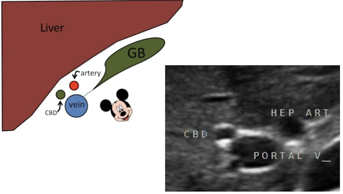 <ul><li><p>consists of portal vein (head), hepatic or bile duct (right ear), and hepatic artery (left ear)</p></li><li><p>makes up the portal triad (in oblique TRANS)</p></li></ul><p></p>