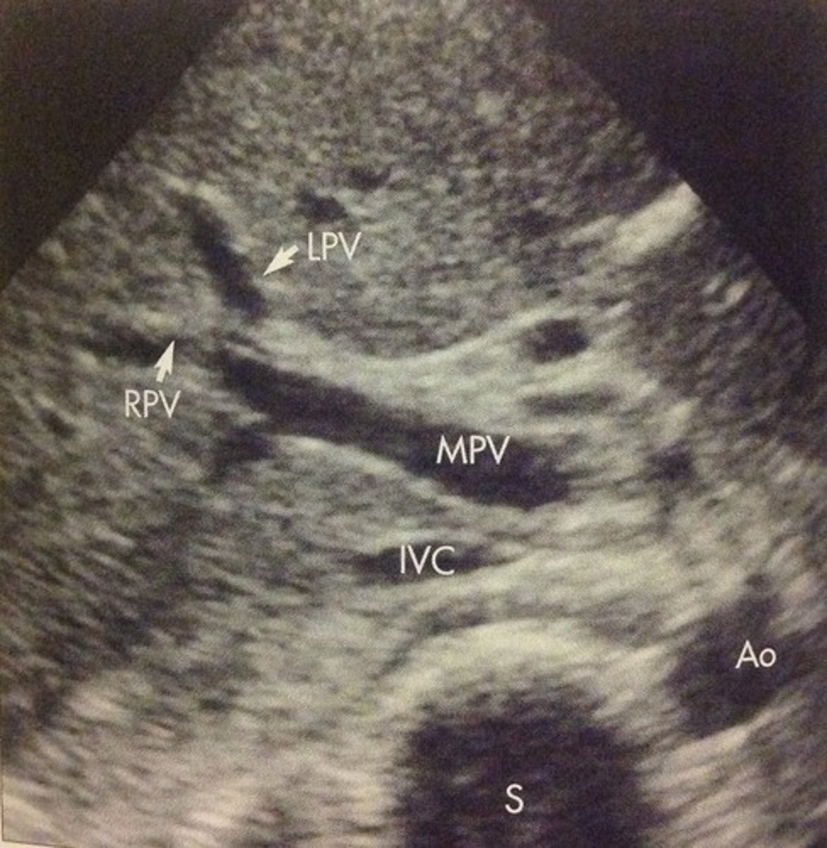 <p>Junction of splenic vein & SMV</p><p>Brings blood from bowel and spleen into liver</p>