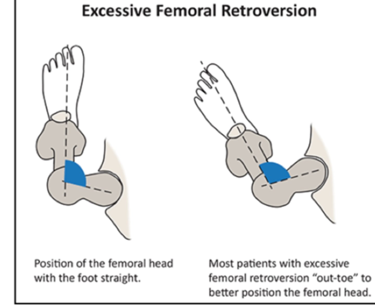 <p>toe out gait to normalize joint congruency</p><p>*may result in compensatory medial torsion of the tibia and pronation of the foot/ankle</p>