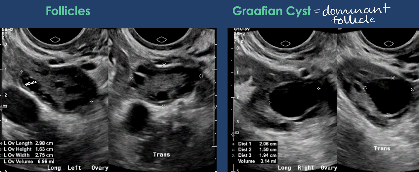 <ul><li><p>ovary measures <strong>3-4 cm</strong> with volume between 4-6 mL</p></li><li><p>ovarian follicles are normally visible</p></li><li><p><span style="color: red;"><strong>dominant follicle</strong> (aka <strong>Graafian cyst</strong>)</span> develops prior to ovulation and <span style="color: red;">measurements ≤ 3 cm</span></p></li></ul><p></p>