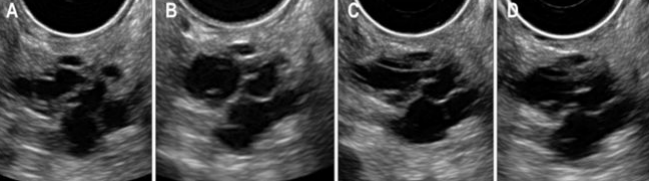 <p>Intraductal Papillary Mucinous Tumor (IPMT)</p>