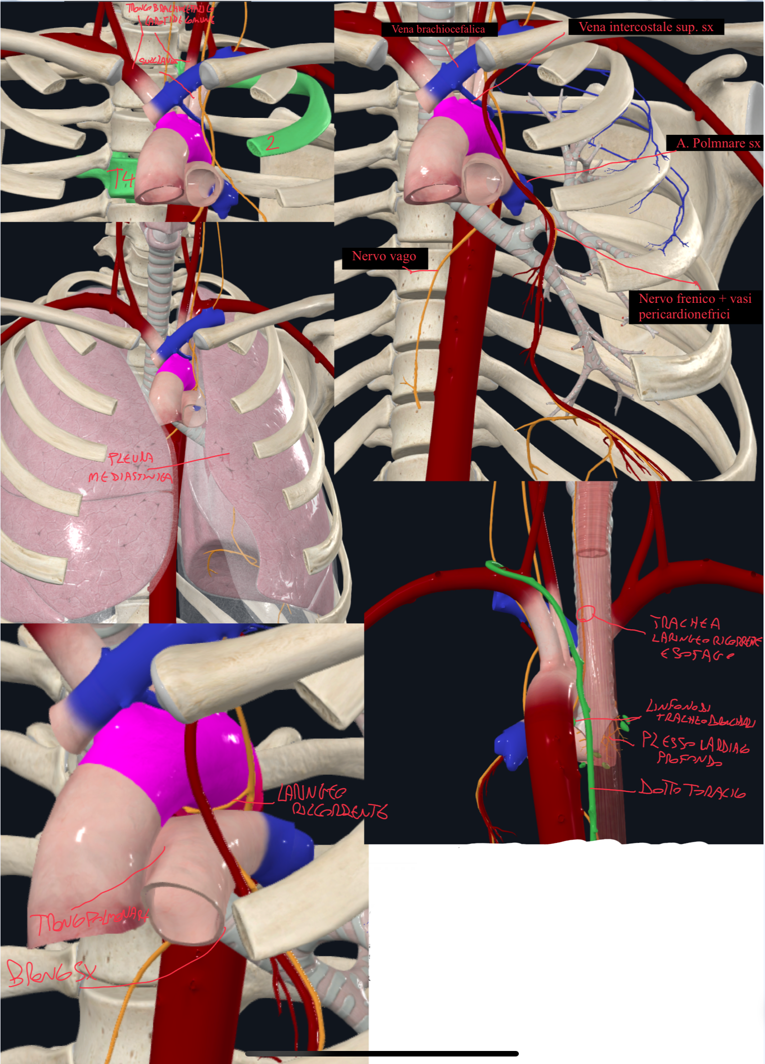 <p>Arco Aortico:</p><ul><li><p>E’ il continuo della aorta ascendente → a livello della 2 articolazione sterno-costale</p></li><li><p>Curva postero lateralmente a sinistra e termina al margine sinistro del corpo di T4</p></li></ul><p>Rapporti Antero sinistri:</p><ul><li><p>Pleura mediastinicia sinistra</p></li><li><p>Nervo Frenico Sinistro (passa anteriormente al peduncolo polmonare) + Vasi Pericardionefrici (dalla toracica interna)</p></li><li><p>Nervo Vago Sinistro (dietro al frenico, che passa dietro al peduncolo polmonare)</p></li><li><p>Vena Intercostale Superiore Sinistra → che vengono dalle intercostali posteriori del secondo terzo e quarto spazio intercostale e sbocca nella vena brachiocefalica sinistra</p></li><li><p>Arteria Polmonare Sinistra</p></li></ul><p>Rapporti Inferiori (sotto l’arco):</p><ul><li><p>Bronco Principale Sinistro</p></li><li><p>Tronco Polmonare</p></li><li><p>Nervo Laringeo Ricorrente Sinistro (ramo del Nervo Vago)</p></li></ul><p>Rapporti Posteriori a destra:</p><ul><li><p>Trachea con dietro l’Esofago</p></li><li><p>Dotto Toracico e Linfonodi Tracheobronchiali superiori</p></li><li><p>Nervo Laringeo Ricorrente Sinistro</p></li><li><p>Plesso cardiaco profondo (tra aorta e trachea)</p></li></ul><p>Rapporti Superiori:</p><ul><li><p>Dietro la vena brachiocefalica sinistra, originano i tre rami:</p><ul><li><p>Tronco brachiocefalico, carotide comune e succlavia sinistra</p></li></ul></li></ul><p>L’arco aortico è nel mediastino superiore</p>