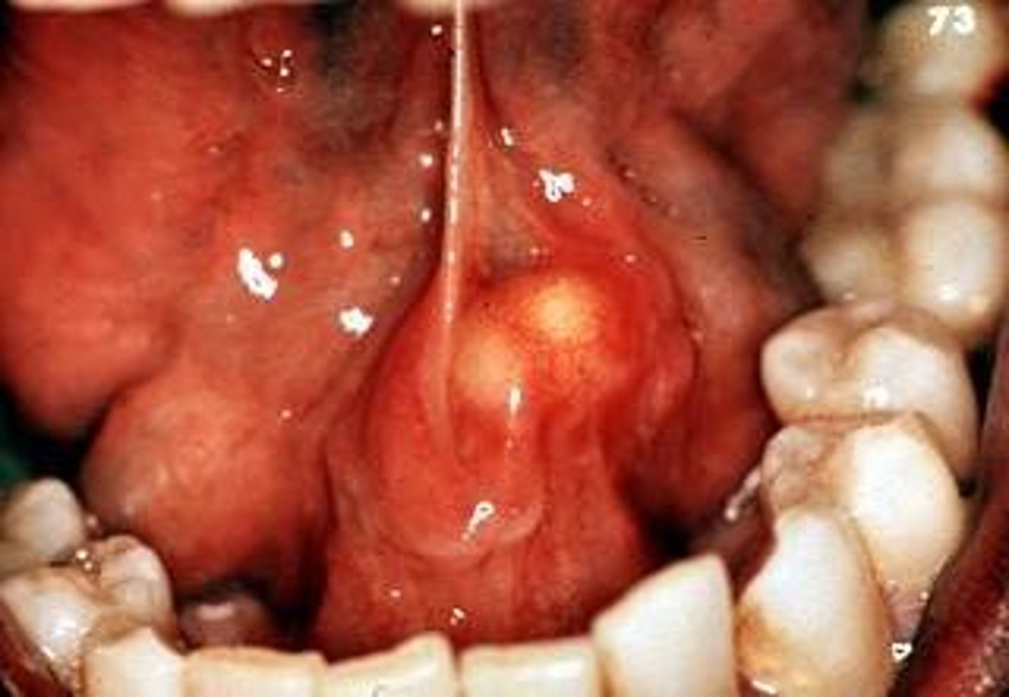 <p>rock-like swelling</p><p>• seen on X-ray </p><p>• common location: floor of mouth</p><p>• increased swelling when eating</p>