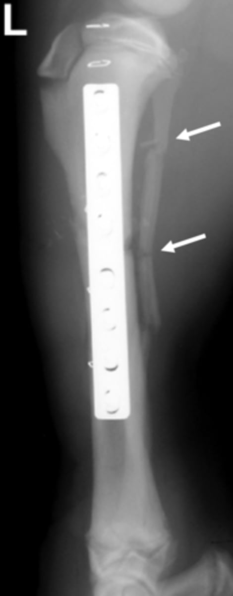<p>Identify the fracture type?</p>