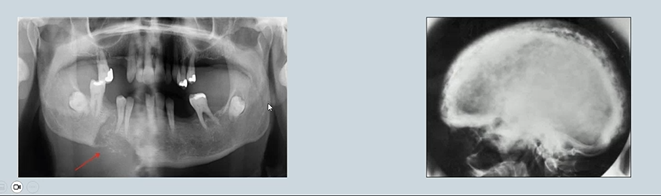 <ul><li><p>Areas of resorption or patchy resorption and sclerosis in the jaws may be due to skeletal disease and associated with changes in blood chemistry.</p></li><li><p> <strong>Paget's disease </strong>→Results in excessive breakdown of bone and dysregulated remodelling. </p></li><li><p>Bony metastases - mental region in the mandible - radiolucency </p></li><li><p>Hyperparathyroidism</p></li></ul><p></p>