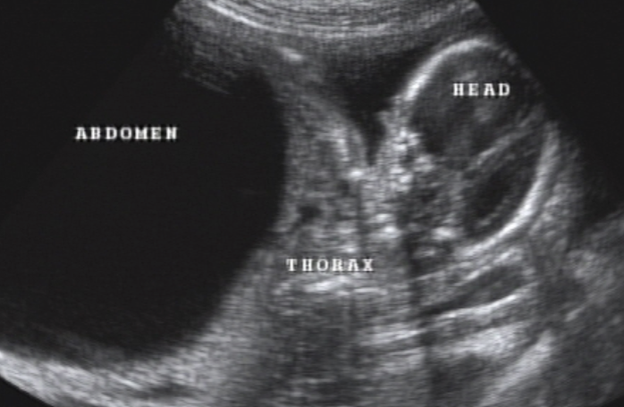 <ul><li><p><strong>distended abdomen</strong></p></li><li><p>oligohydramnios</p></li><li><p>mild-severe hydronephrosis</p></li><li><p><strong>ascites</strong></p></li><li><p>hypoplastic lungs</p></li><li><p>cryptorchidism</p></li><li><p>agenesis of abd wall musculature</p></li><li><p>mega ureter</p></li><li><p>bladder outlet obstruction</p></li></ul><p></p>