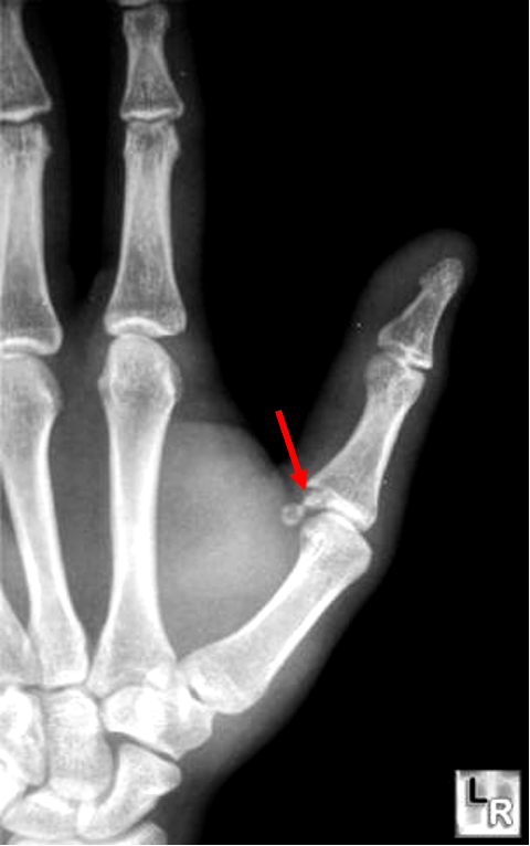 <p>avulsion fx of thumb</p><p>MOI: hyperextension of thumb</p>