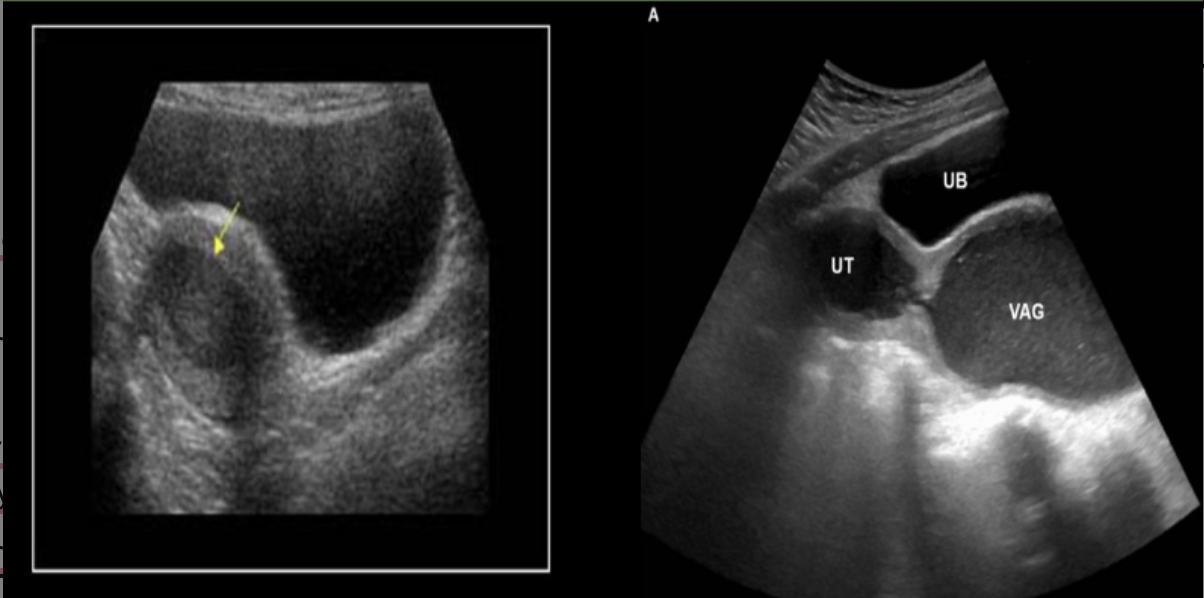 <p>hematometra refers to</p><p>.</p><p>hematometrocolpos refers to</p><p>.</p><p>a) pus dilating uterine cavity, blood + pus dilating uterine cavity</p><p>b) blood dilating uterine cavity, blood dilating uterine cavity, cervix, and vagina</p><p>c) blood dilating uterine cavity, cervix, and vagina, blood dilating uterine cavity</p><p>d) blood dilating uterine cavity, pus dilating uterine cavity</p>