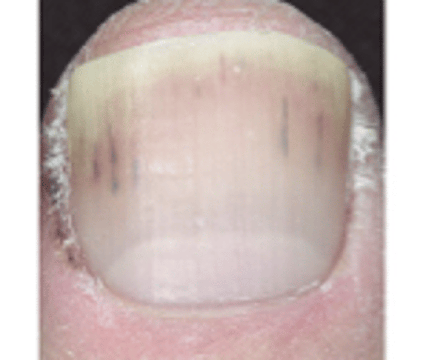 <p>longitudinal, red-brown hemorrhage under a nail that looks like a wood splinter</p>