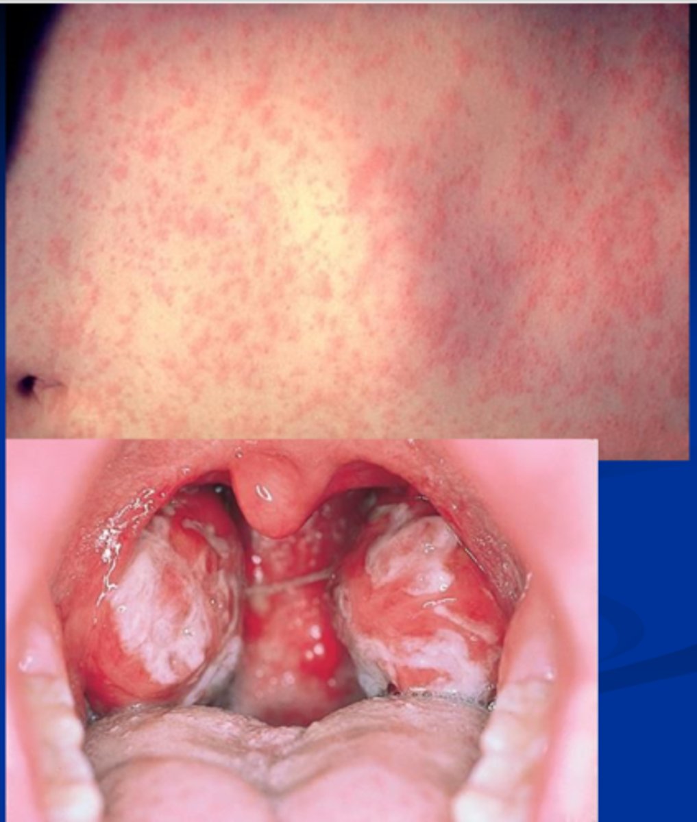 <p>fever, sore throat, swollen lymph nodes (cervical), white tonsils</p>