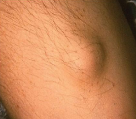 <p>s this a macule, papule, nodule, or lobule </p>