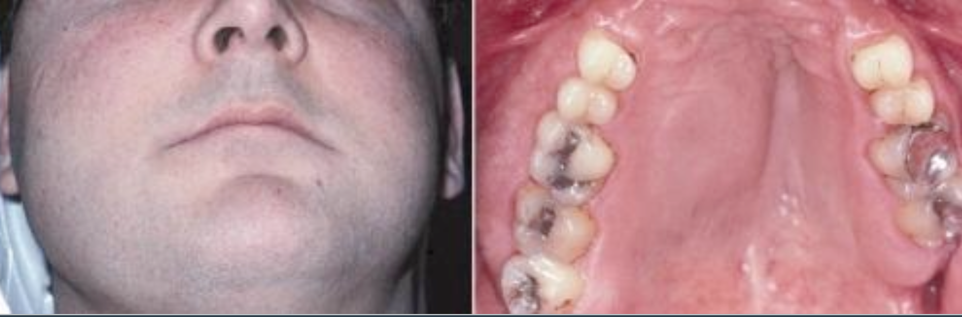 <p>What is the most common feature of Monostotic Fibrous Dysplasia?</p>