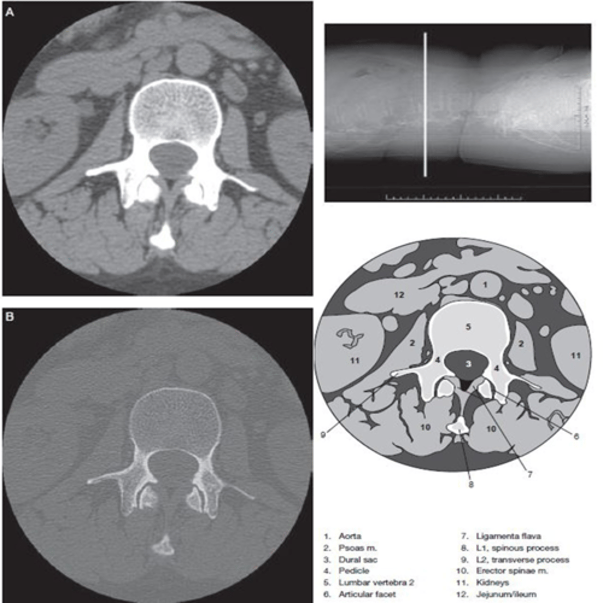 <p>- Contrast-induced nephropathy</p><p>- Allergy to iodinated contrast</p>