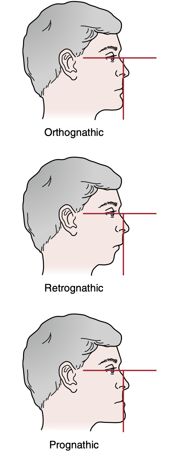 <ul><li><p>Retrognathic</p></li><li><p>Prognathic</p></li></ul><p></p>