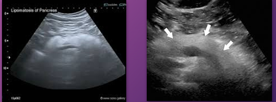 <p>Pancreatic _______ is fat that replaces or infiltrates the pancreas</p>