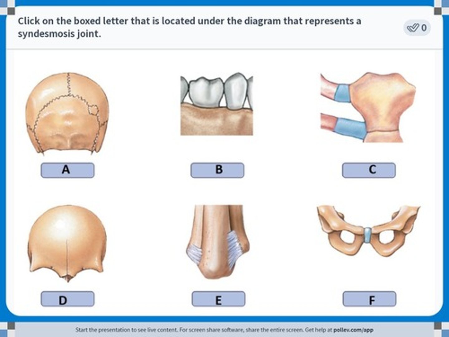 <p>Fibrous joint held together by a ligament.</p>