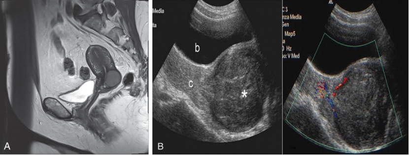 <p>• <em>Small percentage of </em><strong><em>leiomyoma </em></strong><em>(</em><strong><em>myoma tumors, fibroid</em></strong></p><p class="p1"><strong><em>tumors</em></strong><em>) occur in cervix.</em></p><p class="p1">• When myoma is small, patient asymptomatic; as mass enlarges,</p><p class="p1">bladder or bowel obstruction may result</p><p class="p1">• Myoma may be pedunculated and prolapse into vaginal canal.</p><p class="p1">• Sonography may assist in determining the location and</p><p class="p1">thickness of the stalk.</p><p class="p1">• Fluid infusion with sonohysterography enhances visualization.</p>