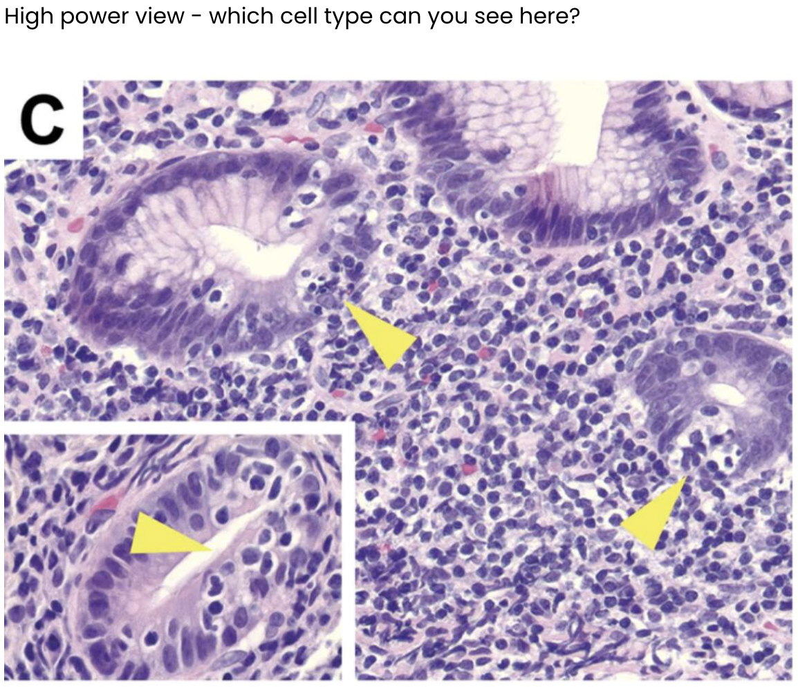 <p>Gland: columnar epithelium + infiltration of lymphocytes</p>