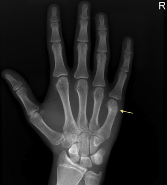 <p>Name this fracture</p>