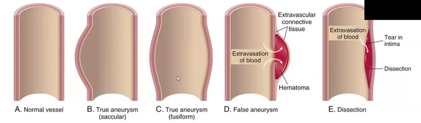 <ul><li><p>When blood enters a defect in the arterial wall and tunnels between layers</p></li><li><p>Can be due to CT abnormality like Marfan’s Syndrome or can be due to hypertension and atherosclerosis → <span style="color: red">HYPERTENSION IS THE MAJOR RISK FACTOR!</span></p></li><li><p><span style="color: red">Double barrel appearance</span>, absent inflammation</p></li><li><p><span style="color: red">Sudden excruciating pain on chest, radiating to the back and moving down</span></p></li></ul><p></p>