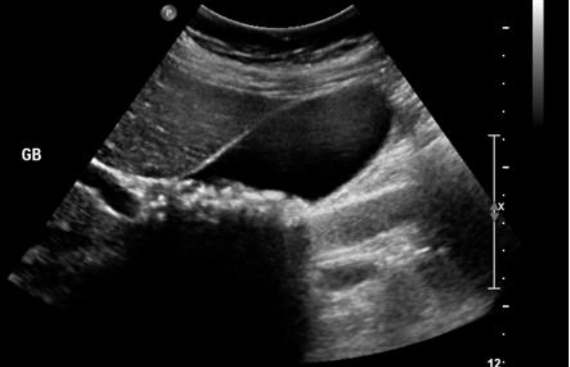 <p>formation of gallstones in gallbladder</p>