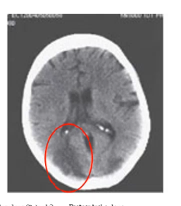 <p>damage to _____ ____ cortex can cause ____ where patients are unable to see more than a limited area of the visual lied at a time, they can see individual objects but cannot perceive a visual scene as a whole </p>