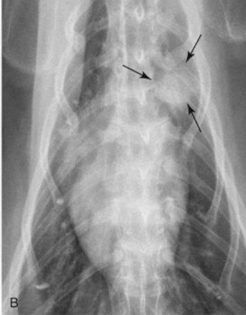 <p>What is the anomaly and who is it seen in? </p>