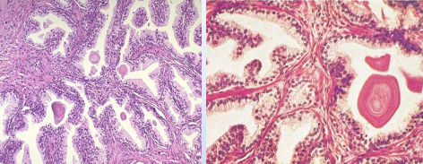 <p>Hiperplasia patológica: hiperplasia prostática benigna. Estímulo desencadenante → andrógenos.</p>