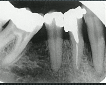 <p>infiltrative, irregular, ill defined radiolucency associated with infection/trauma</p>
