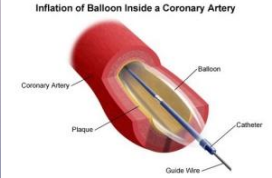 <p><strong>Balloon Angioplasty </strong></p><p>-A specifically designed _________ is placed in a peripheral ______, and a tiny balloon is guided through the artery to a _________ within coronary circulation</p><p>-Balloon is inflated to _____ the opening and _______ blood flow to the heart. Part of PCI</p><p>-_____ is often placed during procedure to keep artery open after the balloon is deflated and removed </p>