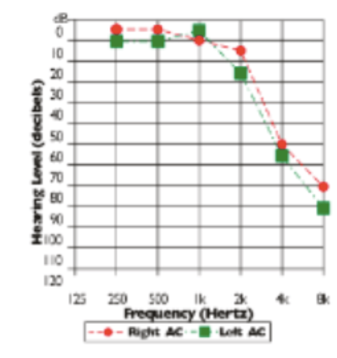 <p>Age related, bilateral sensorineural hearing loss</p><p>High frequency hearing is affected bilaterally -conversational difficulties in noisy environments (hearing is most affected in the presence of background noise)</p><p>Audiometry shows bilateral high-frequency hearing loss</p><p>Precise cause is unknown, is multifactorial</p><p>- Arteriosclerosis – diminished perfusion and oxygenation of cochlea, damage to inner ear structures</p><p>- Diabetes – accelerates arteriosclerosis</p><p>- Accumulated exposure to noise</p><p>- Drugs – salicylates, chemotherapy</p><p>- Stress</p><p>- Genetics</p>
