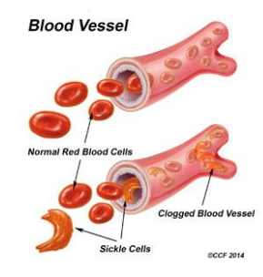 <p>Symptoms generally occur around 6-months</p><p>While there are multiple types of SCD, they all have similar symptoms at different levels of severity. These include:</p><ul><li><p>excessive fatigue or irritability (from anaemia)</p></li><li><p>fussiness (in babies)</p></li><li><p>bedwetting (from associated kidney problems)</p></li><li><p>jaundice (yellowing of the eyes and skin)</p></li><li><p>swelling and pain in hands and feet (ischemia)</p></li><li><p>frequent infections (overworked spleen and ischemia)</p></li><li><p>chest pain (Vaso-occlusive)</p></li></ul>