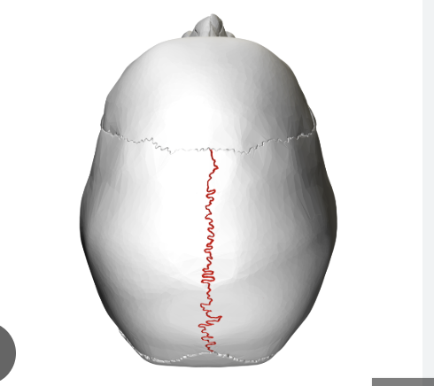 <p>what suture is this? </p>