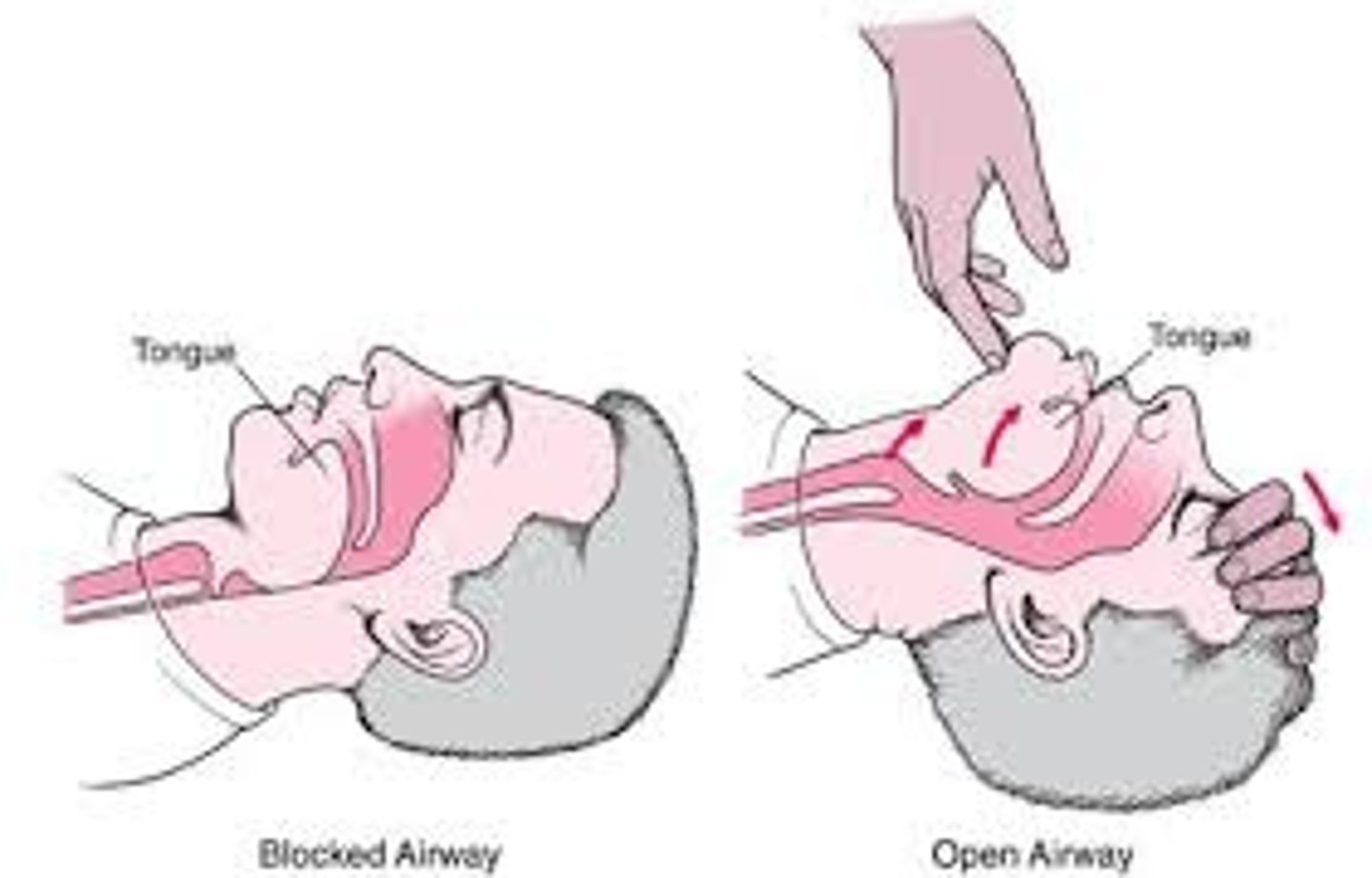 <p>a technique used to open the airway of a patient with no suspected neck or spine injury</p>