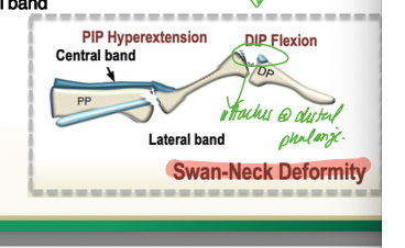 <p>swan neck deformity as the DIP falls into flexion as the lateral band is slackened, and the central band intact continues to pull the PIP into hyperextension </p>