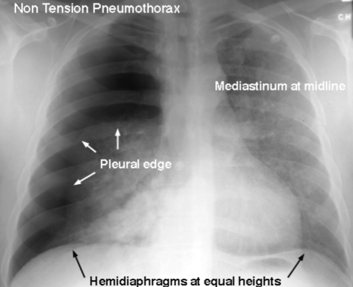 <p>Pneumothorax</p>